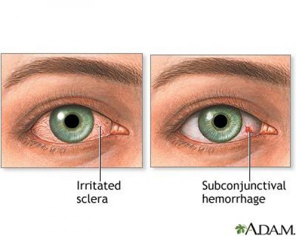 نصائح للتخلص من احمرار العينين