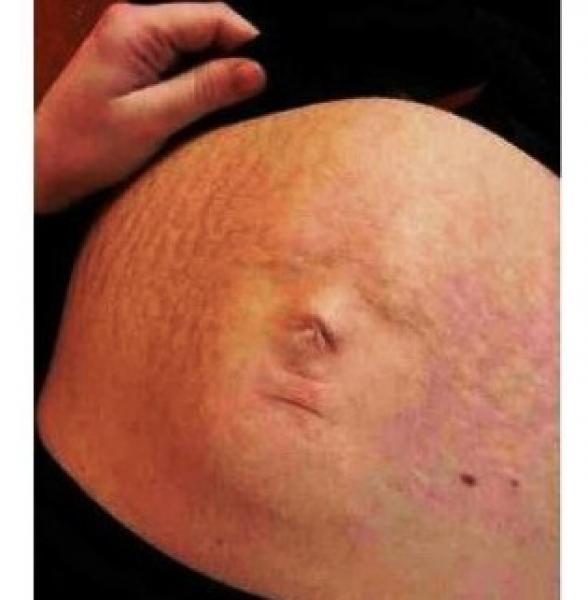 صورة وجه بشري..على بطن إمرأة حامل