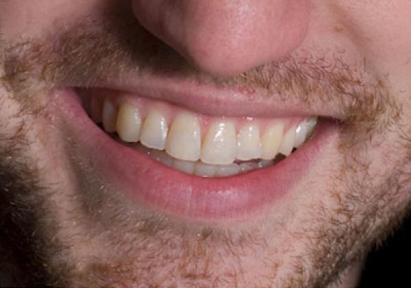 دراسة : أسنان الإنسان بيت الداء لنحو 60%من أمراض القلب