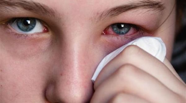 6 أعراض تستلزم استشارة طبيب العيون فوراً