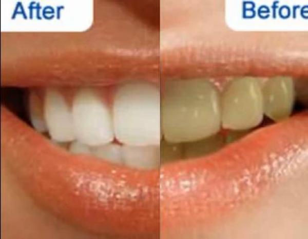 أفضل طريقة لتبيض الأسنان وتنظيف اللثة بدون الذهاب إلى الطبيب   