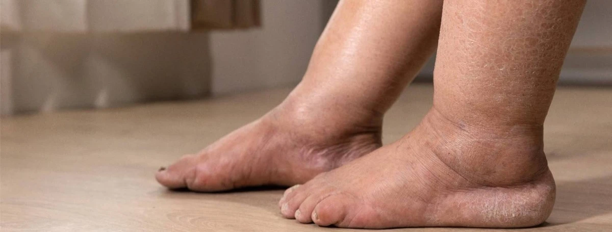 الوذمة الشحمية.. اضطراب يصيب النساء وقد يُخلط بينه وبين زيادة الوزن