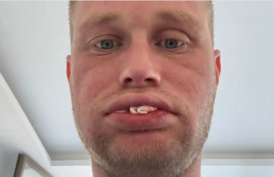 بريطاني سافر إلى تركيا لتجميل أسنانه لكنه فقدها كلها