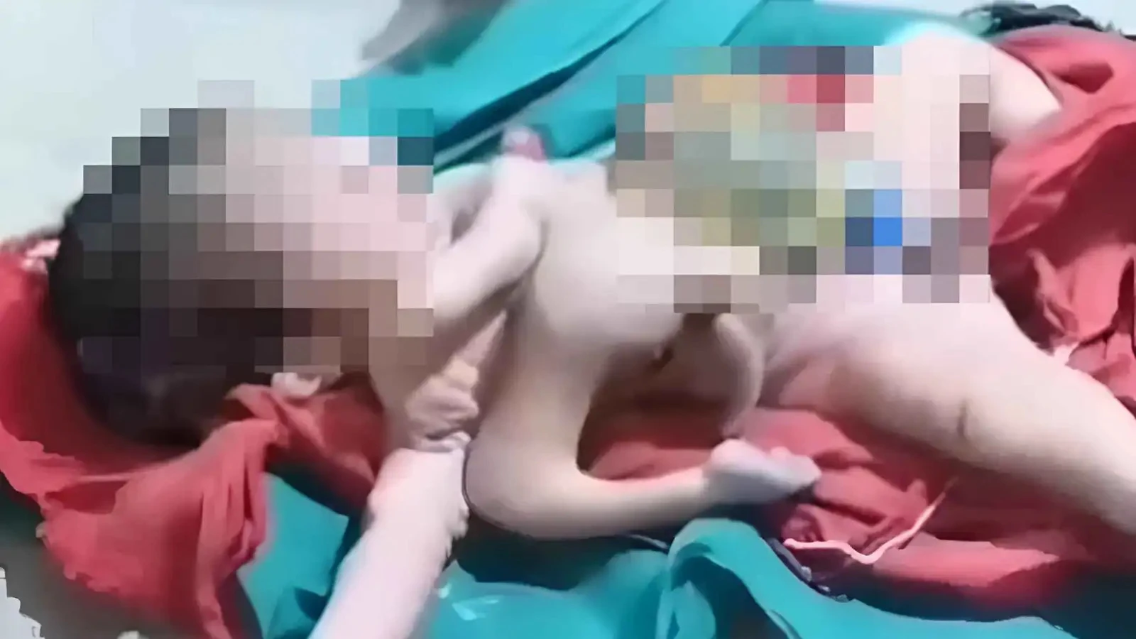 ولادة نادرة تهز الهند.. طفل يولد بـ8 أطراف ويصدم الأطباء