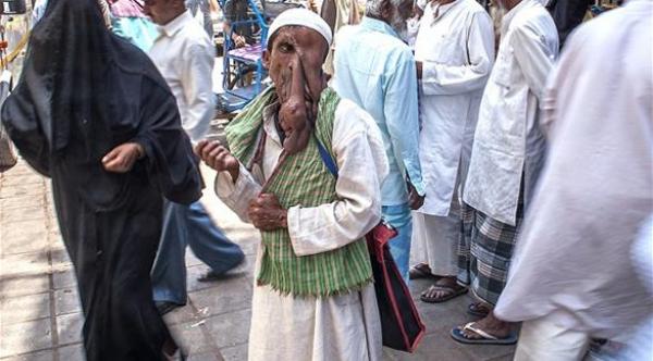 رجل يعاني من ورم ضخم في وجهه يرفض الجراحة ليتابع التسول