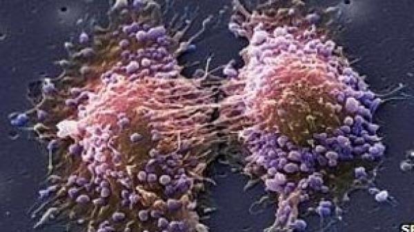 اكتشاف جين يرتبط بنمو سرطان البروستاتا