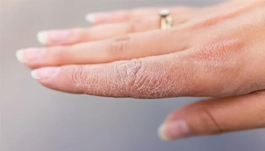 3 علامات جلدية خفية قد تكشف الإصابة بالسكري من النوع 2