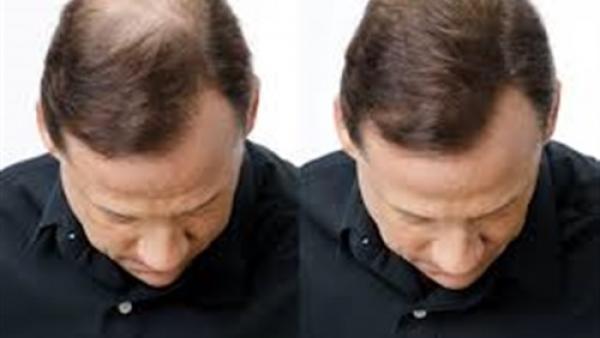 وصفة غذائية تعالج الصلع في 5 أيام