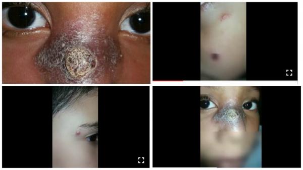 أخيرا وبعد مقال "أخبارنا"...وزارة الصحة تلقح الأطفال المصابين بوباء "اللشمانيا" وارتفاع عدد حالات المصابين