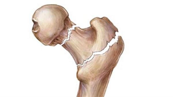 10 أسباب تؤدى إلى هشاشة العظام