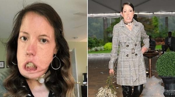إمرأة لم يمنعها تشوه في وجهها من العثور على عمل في مجال الأزياء