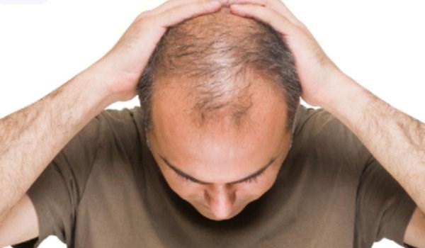 8 أسباب "غير متوقعة" لتساقط الشعر