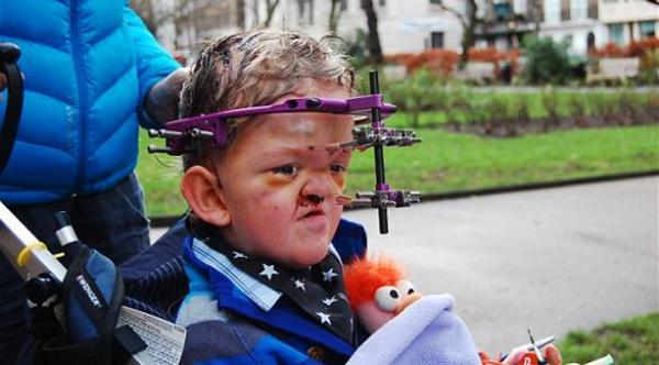 صورة: 50 عملية جراحية لإعادة بناء وجه طفل