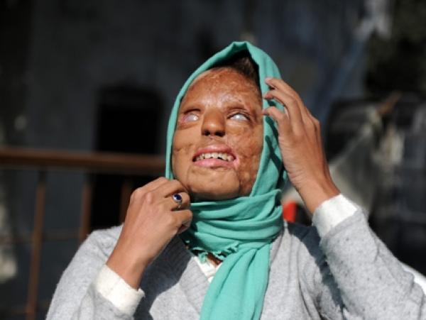 هندية تعرضت لاعتداء بالحمض الكاوي.. وأصبحت مليونيرة