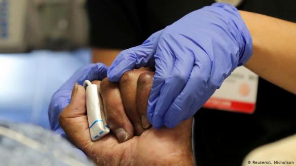 وفاة أول أمريكية خضعت لعملية زرع وجه