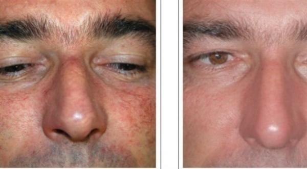 ما أسباب انفجار الشعيرات الدموية في الوجه؟