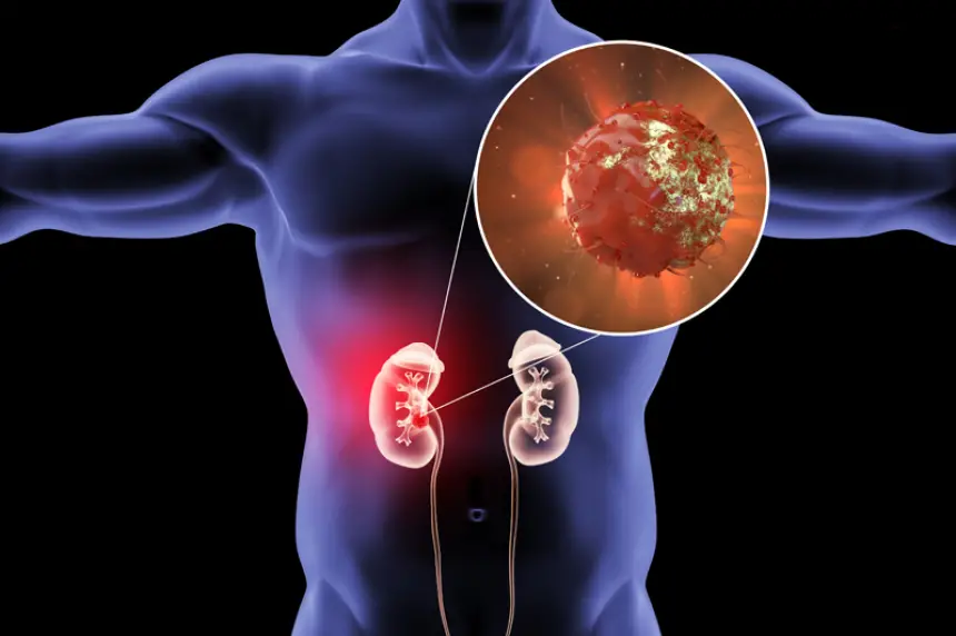 ثورة طبية.. الذكاء الاصطناعي يكشف سرطان الكلى في وقت قياسي