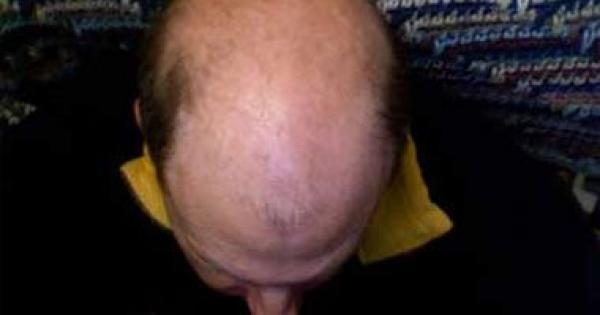 دراسة طبية: انتفاخ العين والصلع من علامات التعرض لذبحة صدرية لدى الرجال