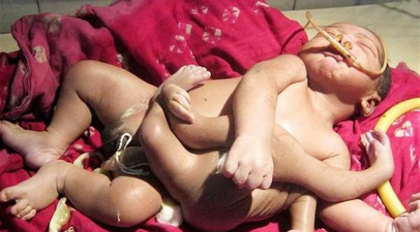 ولادة طفل بثمانية أطراف في الهند