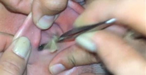 بالفيديو والصور.. إخراج فراشة حية من أذن شاب أمريكي