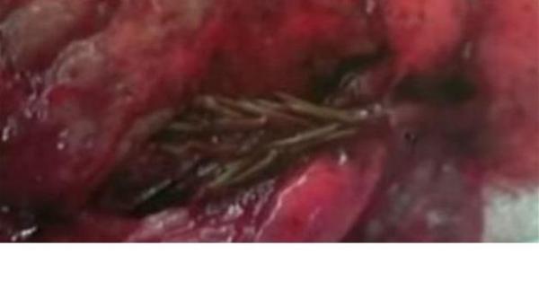 تعرف على أغرب 4 أجسام عثر عليها الأطباء في رئات مرضاهم