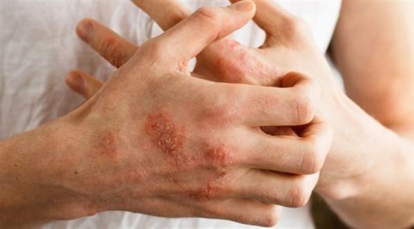 حذاري من الغسل المتكرر لليدين..تهديد الإصابة بالإكزيما