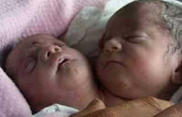 رضيعة مغربية ولدت برأسين