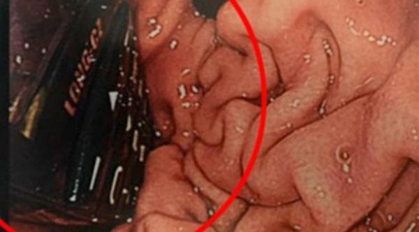 بالصورة: سجين يبتلع هاتفاً محمولاً.. فما النتيجة؟