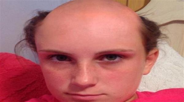 استخدمت مزيل الشعر بدل الشامبو فهذا ما حدث لها