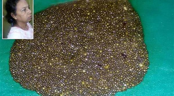 استخراج 12 ألف حصوة من معدة امرأة هندية