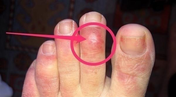 اكتشاف علامات مبكرة للإصابة بكورونا لدى الأطفال تسبق ظهور الأعراض الأخرى