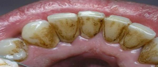 طريقة فعالة و سهلة لإزالة الرواسب البيكتيرية من باطن أسنان الفم