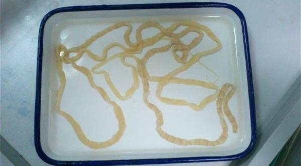 هذه الدودة كانت تعيش بالفعل داخل دماغ رجل و هذا هو السبب ..