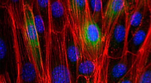 علاج جديد لسرطان الثدي: إعادة تشكيل الخلايا