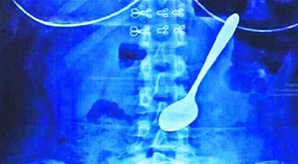 طالبة تبتلع ملعقة بالخطأ أثناء تناولها للآيس كريم