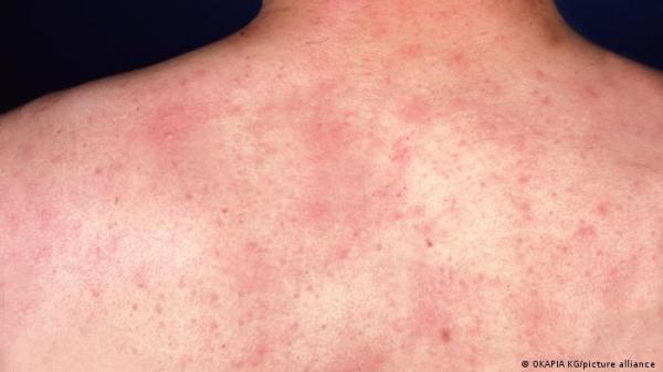 "شرى البرد".. حساسية يمكنك تهدئة أعراضها المزعجة بهذه الطرق!