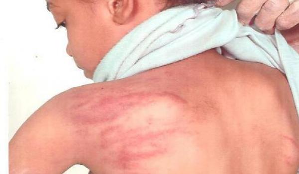  أثار الضرب على ظهر الطفلة التي تقول إنها ناتجة عن ضرب المعلم