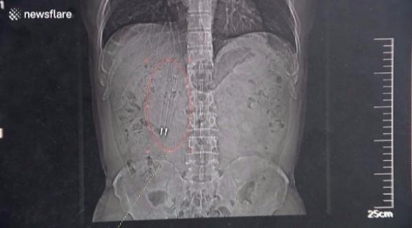 استخراج قلمين من معدة رجل بعد 36 عاماً من ابتلاعهما