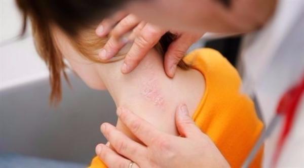 طفلك مصاب بالصدفية؟ هذه الفحوصات مهمة