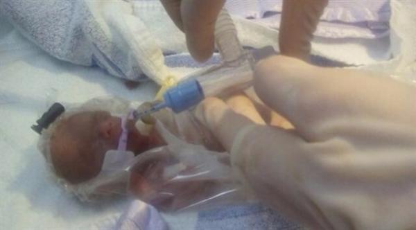 طفلة معجزة بحجم كرة تنس تتحدى توقعات الأطباء