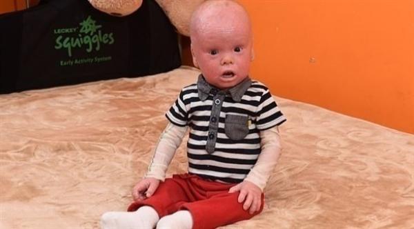 حالة نادرة تجعل من طفل شبيها بالدمى