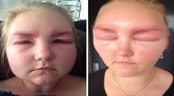 صبغة الحواجب تتسبب في انتفاخ شديد في وجه عروس بريطانية