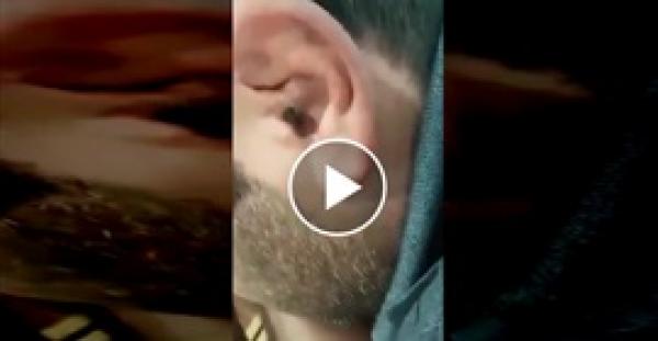 بعد شكواه من الشعور بحكة مستمرة،طبيب يخرج «أم 44» من أذن شاب (فيديو)
