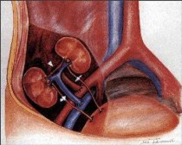 20 في المائة من مرضى الفشل الكلوي مقصيون من زراعة الكلي