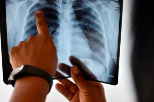 الصحة توضح حقيقة استقبال مراكز تشخيص مرض السل للمرضى مرتين فقط في الأسبوع