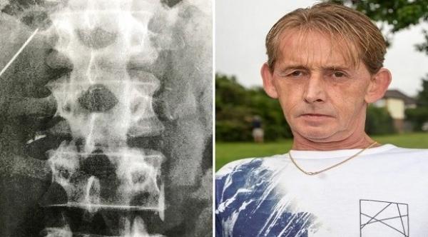 رسام بريطاني يكتشف وجود إبرة خياطة مغروسة في كبده لمدة 15 عاماً