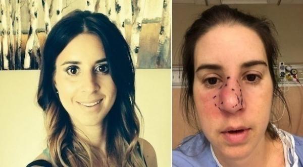 تقرر  إزالة أنفها بالكامل بسبب آلامها المبرحة