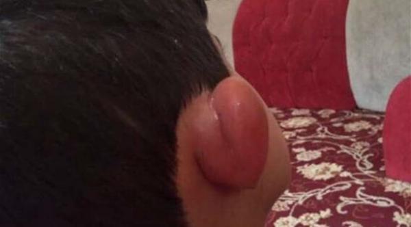 بالصور: قرية سعودية تطلق مسابقة "أجمل لسعة بعوض"