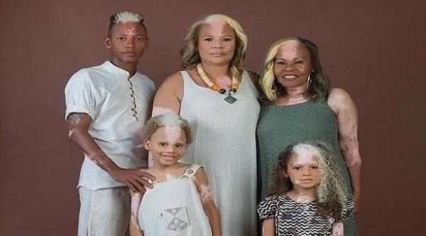 عائلة مصابة بحالة وراثية نادرة تسببت بظهور بقع غريبة