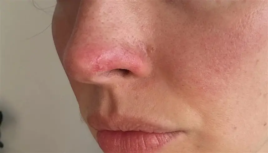 تحذير من حالة نادرة.. فتاة تُصاب بالوردية في سن مبكرة بعد حروق شمسية